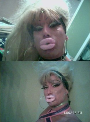 Жертвы пластической хирургии