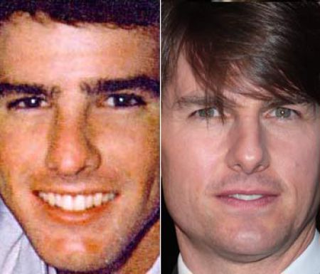 Носы знаменитостей До и После операции Носы знаменитостей До и После операции