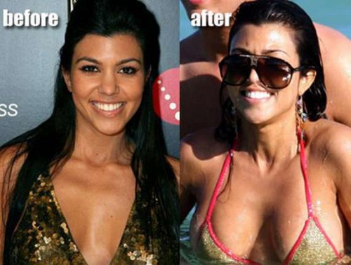 Звезды до и после увеличения груди