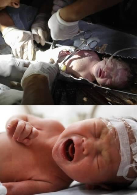 8 Удивительных новорожденных, которые пережили невозможное