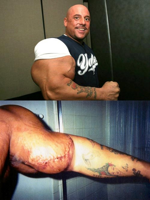 10 шокирующих результатов злоупотребления стероидами