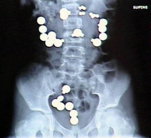 Настоящие рентгеновские снимки, которые шокируют и удивят вас (21 фото)