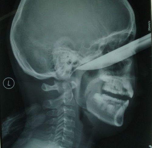 Настоящие рентгеновские снимки, которые шокируют и удивят вас (21 фото)