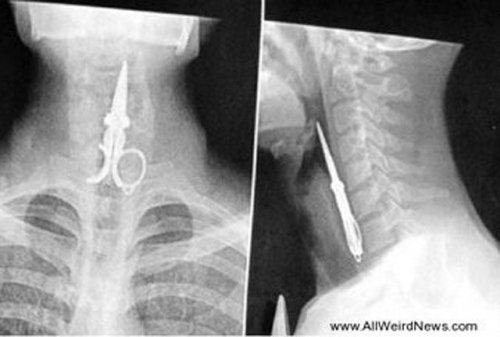 Настоящие рентгеновские снимки, которые шокируют и удивят вас (21 фото)