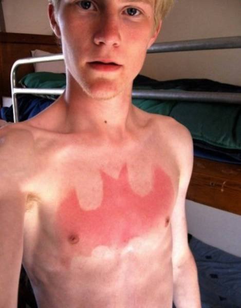 Неудачный загар, который поднимет настроение всем, кроме его обладателей (17 фото) Неудачный загар, который поднимет настроение всем, кроме его обладателей (17 фото)