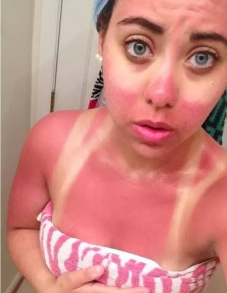 Неудачный загар, который поднимет настроение всем, кроме его обладателей (17 фото) Неудачный загар, который поднимет настроение всем, кроме его обладателей (17 фото)