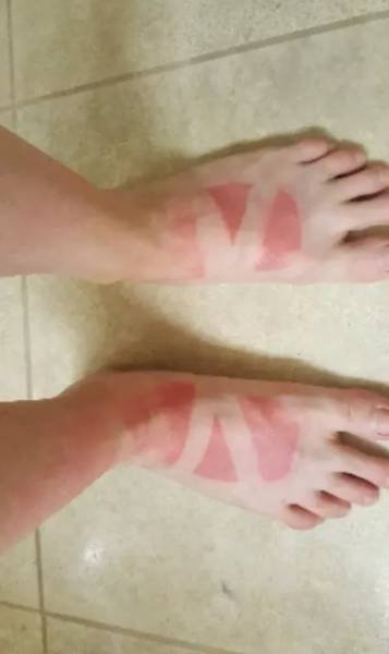 Неудачный загар, который поднимет настроение всем, кроме его обладателей (17 фото) Неудачный загар, который поднимет настроение всем, кроме его обладателей (17 фото)