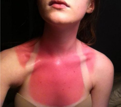 19 человек, которые не воспользовались солнцезащитным кремом и пожалели об этом
